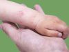 Home Remedies for Dermatitis Healing