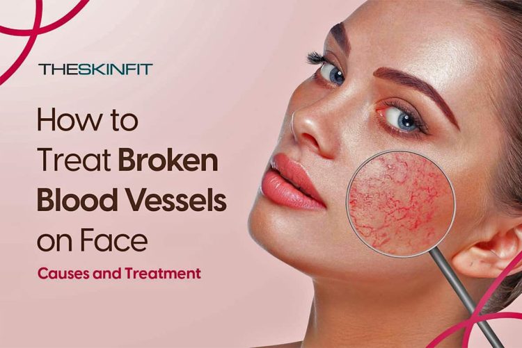 Broken Blood Vessels On Face And How to Treat