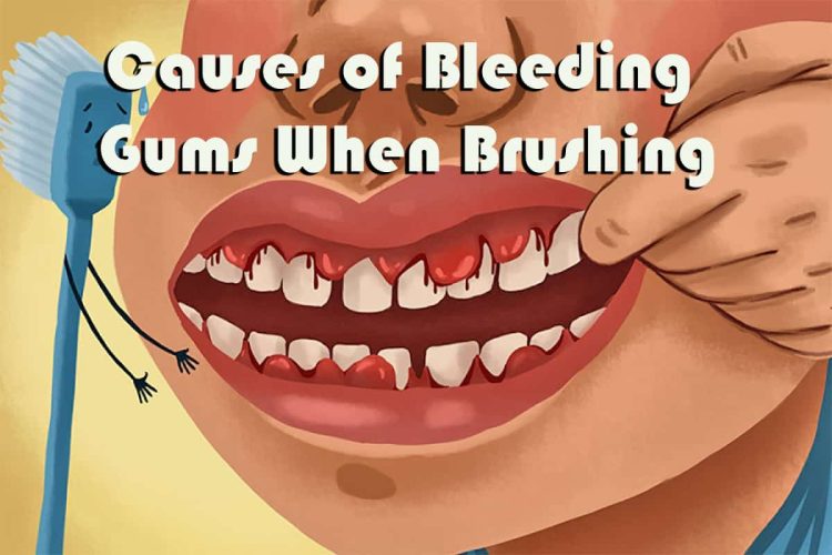 Causes of Bleeding Gums When Brushing