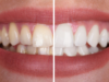 How to Prevent Calcium Buildup on Teeth