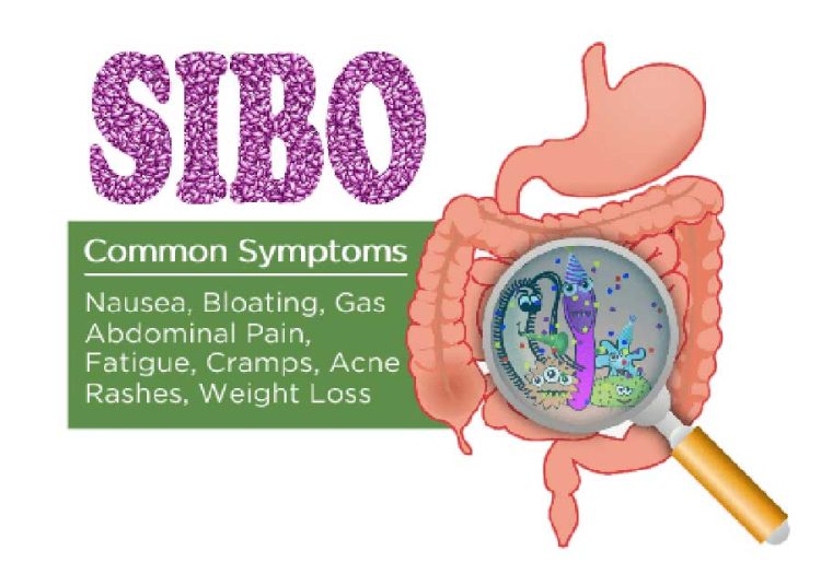 Natural Remedies or Treatment for SIBO